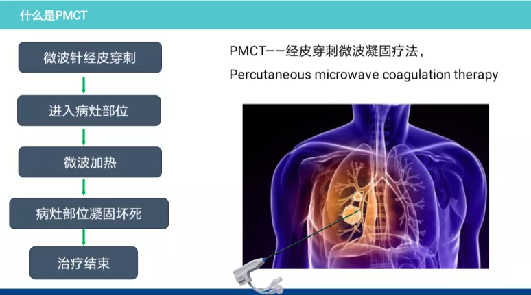 江西省胸科医院肿瘤二科完成一例恶性肿瘤肺转移高难度微波消融术